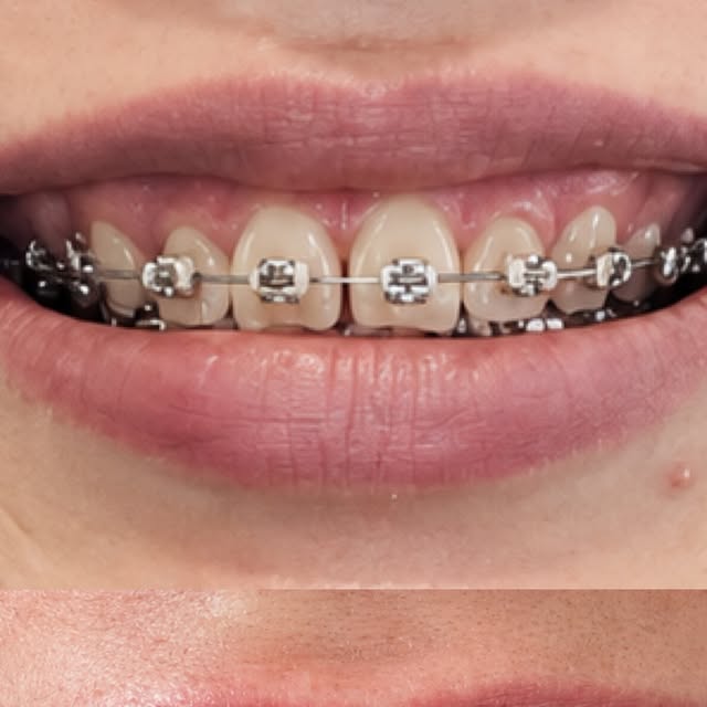 Caso clínico en tratamiento de estética dental